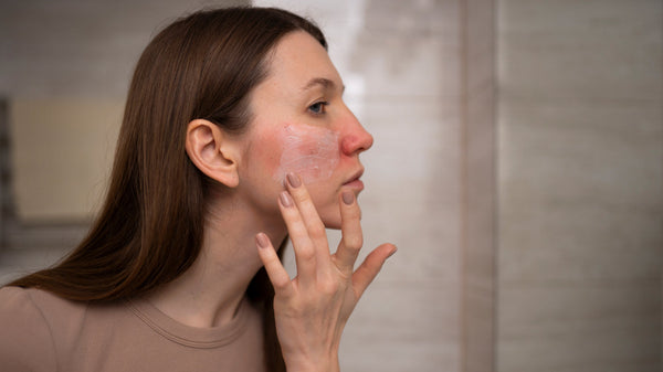 How to Heal your Skin Barrier